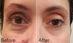 كريم للهالات السوداء والانتفاخات حول العين